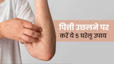 पित्ती उछलने पर करें ये 5 घरेलू उपाय, मिलेगी चकत्तों और खुजली से राहत